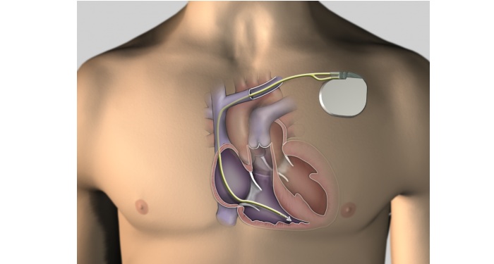 défibrillateur implantable télémédecine